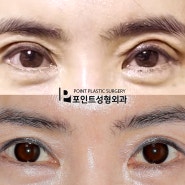 여러차례의 쌍꺼풀재수술로 인한 부자연스러운 눈매 조기재수술 포인트성형외과 수술전후사진