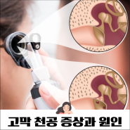 고막천공 증상 귀 통증 중이염 원인 치료방법