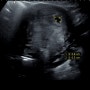 [임신 일기] 소파술 후 첫 생리만에 재임신한 후기