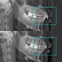 정왕역 치과 deep bite(과개교합) 및 돌출 개선 증례, 단 2년 밖에 걸리지 않았다?