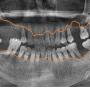 길동 치과 임플란트 뼈이식 흡연 관련 있을까?