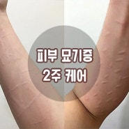 피부묘기증 원인 알아보고 가려움 2주 해결