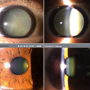 [판교안과] 고난이도 노안백내장 수술 white cataract case review