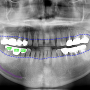 상인동 치과 임플란트 브릿지는 치아에 문제를 초래할 수 있습니다. (임플란트 치료)