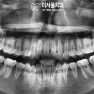 성남 치과 에서 알려드리는 인비절라인 교정 후기 (기간, 통증, 가격)