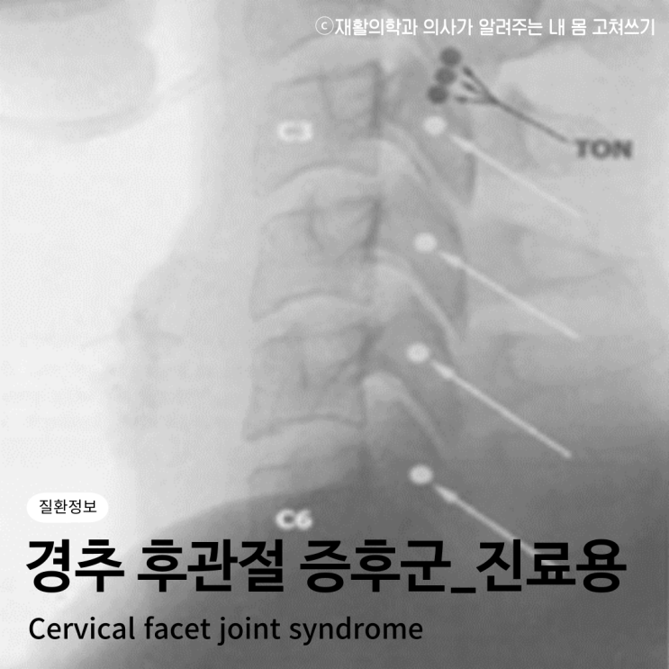 경추 후관절 증후군(Cervical facet joint syndrome)_【진료용】 : 네이버 블로그