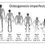 골형성부전증骨形成不全症Osteogenesis imperfecta 포항한의원 오천읍 허한의원