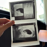 👼🏻 | 임신 7주 2일차 | 아기 크기 1.18cm | 평균 140bpm으로 뛰는 심장소리