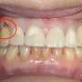 이가 시린 이유, 치경부마모증