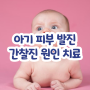 아기 피부 발진 간찰진 치료 원인