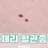 체리 딸기 혈관종 원인 제거 레이저 말고 뭐가 있을까?