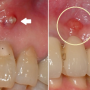 천안,두정동치과) 잇몸에 여드름이 난다! 치료는 타이밍!