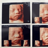 임신29주 신도림 아름제일 입체초음파 꿀팁 가격
