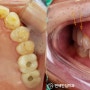 수원역 치아 통증 나타난 곳, 상악동거상술을 이용한 어금니 임플란트 치료 후기