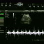임신 난황 주수별 태아 심장소리, 평균 아이 길이 CRL (mm)