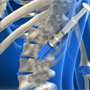 수내통증의학과 목 허리디스크 신경차단술, 재발 없을까?