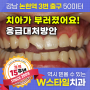 [논현역 치과] 치아가 부러졌다면? 어떻게 대처해야 할까?