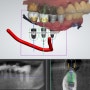 성남 치과 에서 수면마취(의식하 진정요법)를 동반한 디지털 임플란트 과정
