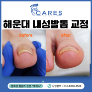 해운대 내성발톱 파고든 발톱 교정 놓치지 마세요