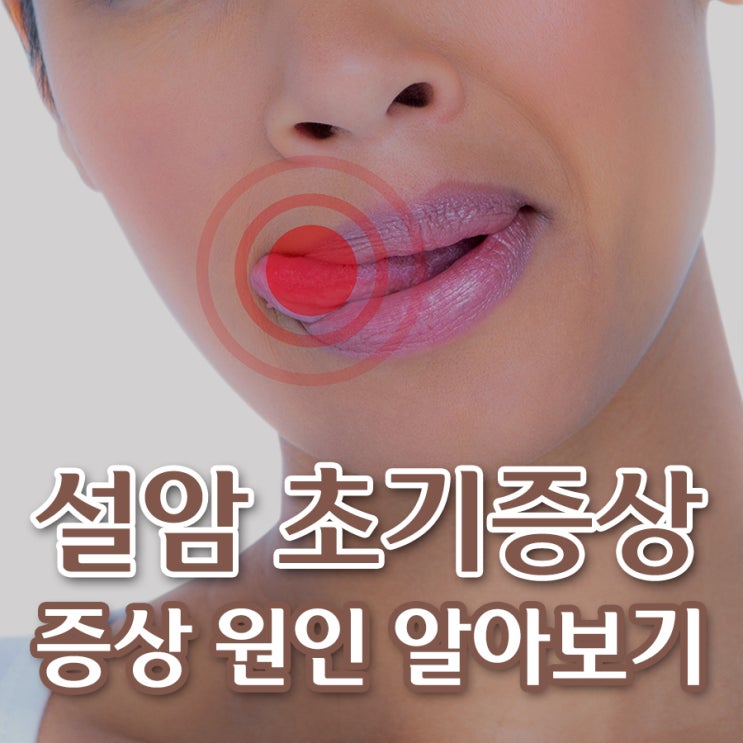 설암초기증상 설암증상 혀암증상 어떤 증상들이 있을까요 : 네이버 블로그