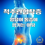 척추관협착증으로 엉덩이 통증이 생기는 이유: 원인, 증상, 치료 및 예방