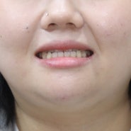 주걱턱과 경추의 관계 목통증? 그리고 얼굴비대칭 교정치료
