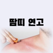 성인 땀띠 연고 치료 기간 리도멕스 비판텐 약국(아이 땀띠)