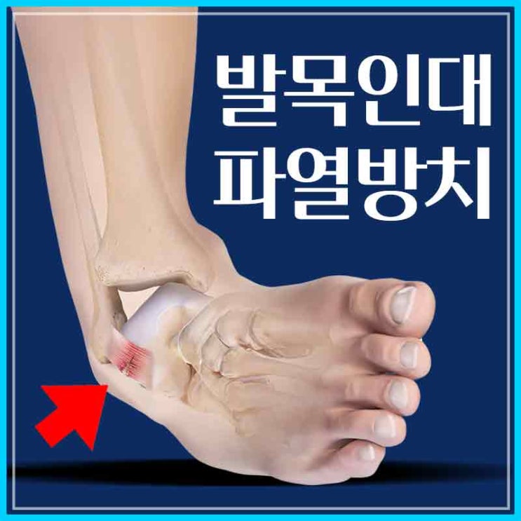발목인대 완전파열 증상 방치 말고 깁스만 잘 해도 봉합술 보다 낫다? : 네이버 블로그