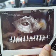 임신 초기 5주~9주 : 뒤늦은 임신 확인과 산전검사 그리고 입덧 지옥