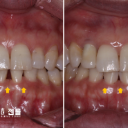 [블랙트라이앵글 레진 / 치과더젠틀] 치아교정 후에 남아 있는 앞니 블랙트라이앵글(블트)을 레진 치료로 개선한 증례.