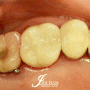 강동구 치과 에서 어금니 파절(깨짐) 치아 신경치료 후 크라운 보철 수복으로 발치 없이 기능 회복한 과정