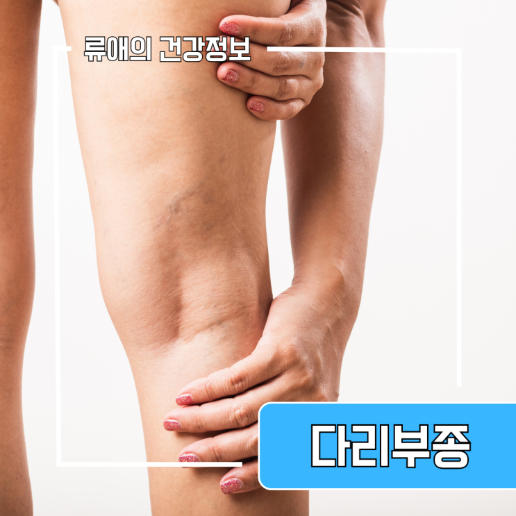 다리부종 원인 증상 치료 마사지 대처의 중요성 : 네이버 블로그