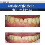 대구레진치료 잘하는 치과 : 치아 사이가 벌어졌어요..