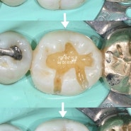 종로 5가 치과 오래된 아말감 충치 레진으로 교체한 사례