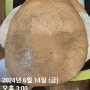 재발 반복되는 원형탈모, 전두탈모, 난치성탈모 ; 분당탈모 서현역원형탈모 연어약침 판교자하거약침 수내동사독약침