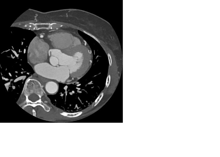 Anomalous origin of left circumflex (LCX) artery from right coronary ...