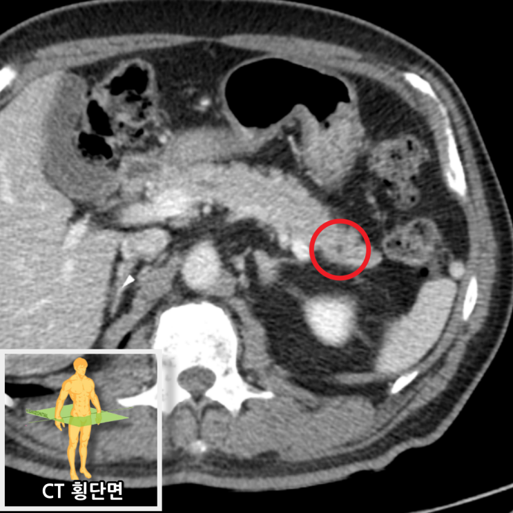 췌장암 검사 방법! 복부CT, 췌장MRI 비교 : 네이버 블로그