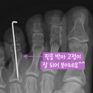 발가락 골절 도수정복술 후 틀어져서 pinning수술 증례보고