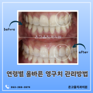 전주치과, 연령별 올바른 영구치 관리방법은?