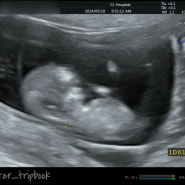 임신 11W-14W #3 1차 2차 기형아 검사
