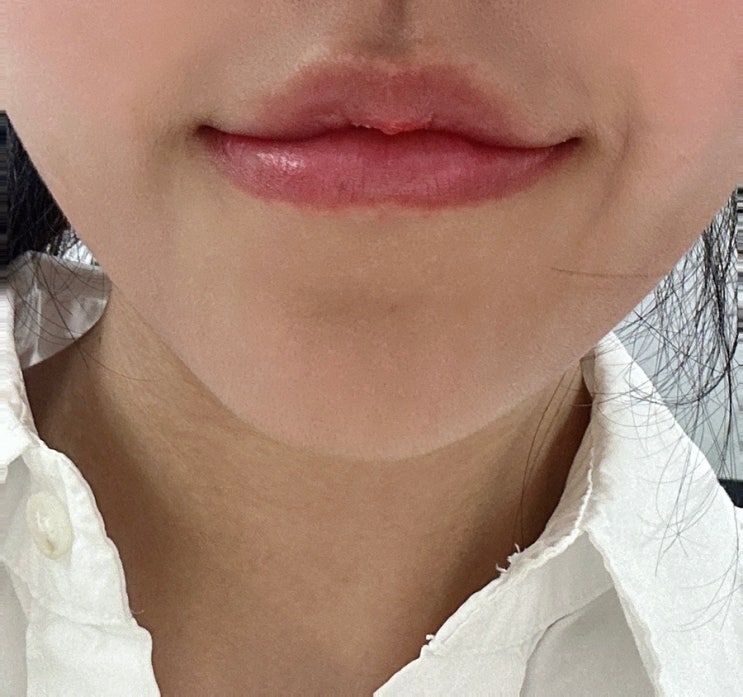 예비신부관리 2번째 입술필러 입꼬리보톡스 솔직후기 (내돈내산) : 네이버 블로그