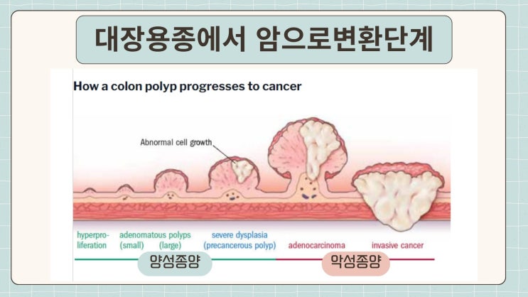 대장암 분쟁(점막내암) : 네이버 블로그