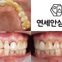 매탄동 치과 "양쪽 어금니 불편해요" 치아 통증 있던 곳 발치 후 즉시 임플란트 식립 과정은?