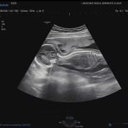 임신 17주 18주차 증상 임산부 배 크기 그리고 일상
