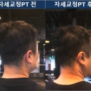[자세교정] 40대 고개 돌릴때마다 목통증 호소 Before & After