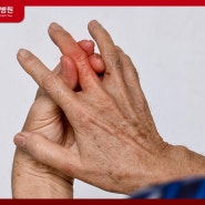 중지 손가락 골절 응급처치가 중요한 이유