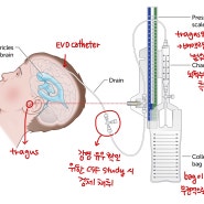 [NS] EVD (External Ventricular Drain) 뇌실외배액