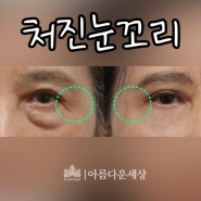 처진눈꼬리 없애려고 선택한 눈처짐수술