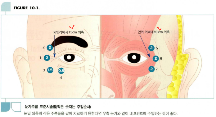 [보톡스] (3) 눈가주름(Crow's feet; Lateral canthal rhytides) : 네이버 블로그