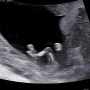임신12주-16주 1차 2차 기형아검사 시기 비용 니프티 검사결과 태아성별확인